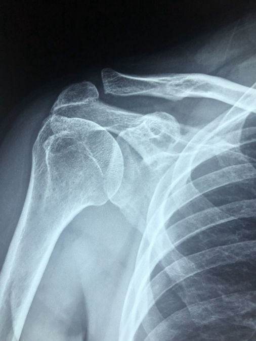 rotator cuff