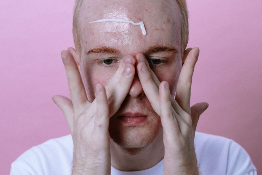 severe acne